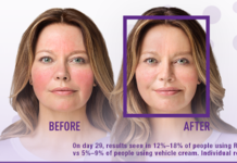 “Fake Advertising”: Allergan Should Be Red in the Face for Using “Before & After” Images in Rhofade & Kybella Ads