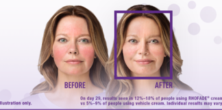 “Fake Advertising”: Allergan Should Be Red in the Face for Using “Before & After” Images in Rhofade & Kybella Ads